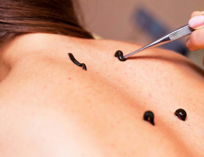 Гирудотерапия - Санаторий «им. Воровского»